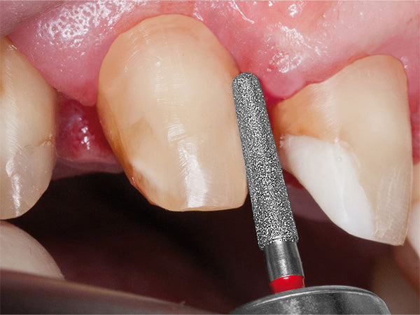 example of clinical use of 8856 diamond bur during crown preparation