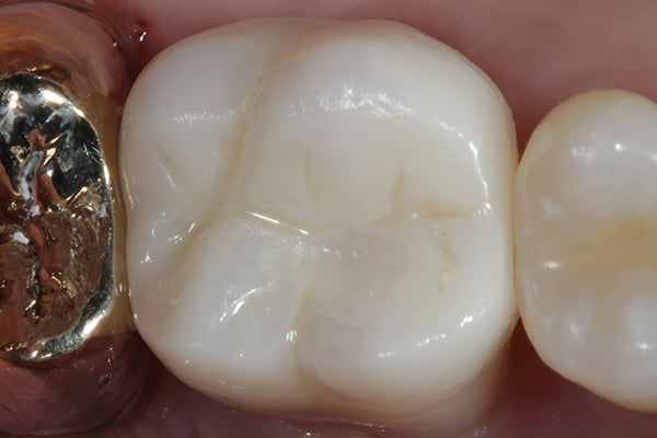 bonded ceramic crown