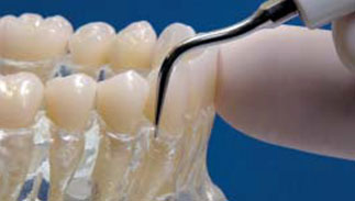 Scaling pockets < 2-3mm. Supra-gingival scaling for children and shallow pockets scaling.