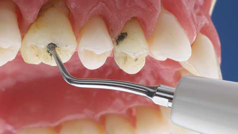 Acteon Excavus EX1 tip: Ball diamond tip (76μm). Preparation of the occlusal surface and cervical margins.