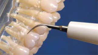 Universal tip. Treating simple cases and gross supra-gingival scaling.