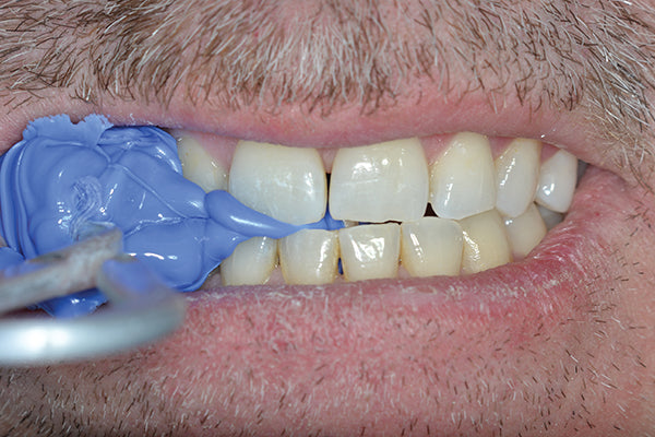 Affinity Clinical Technique Tray in Mouth