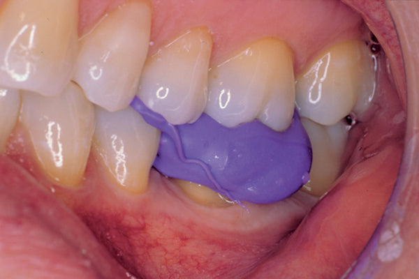 Affinity Quick Bite Intraoral Clinical