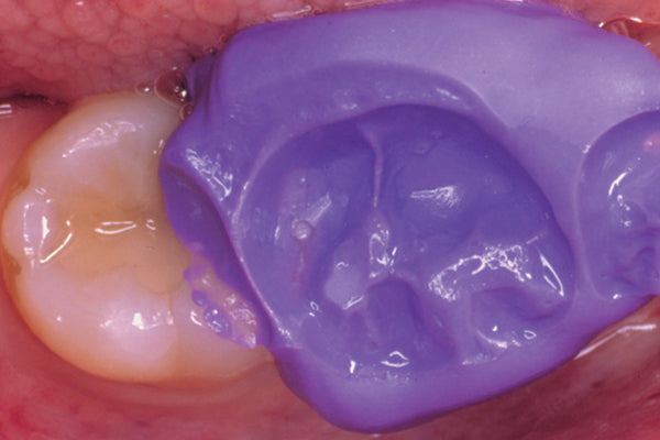 Affinity Quick Bite Impression Clinical