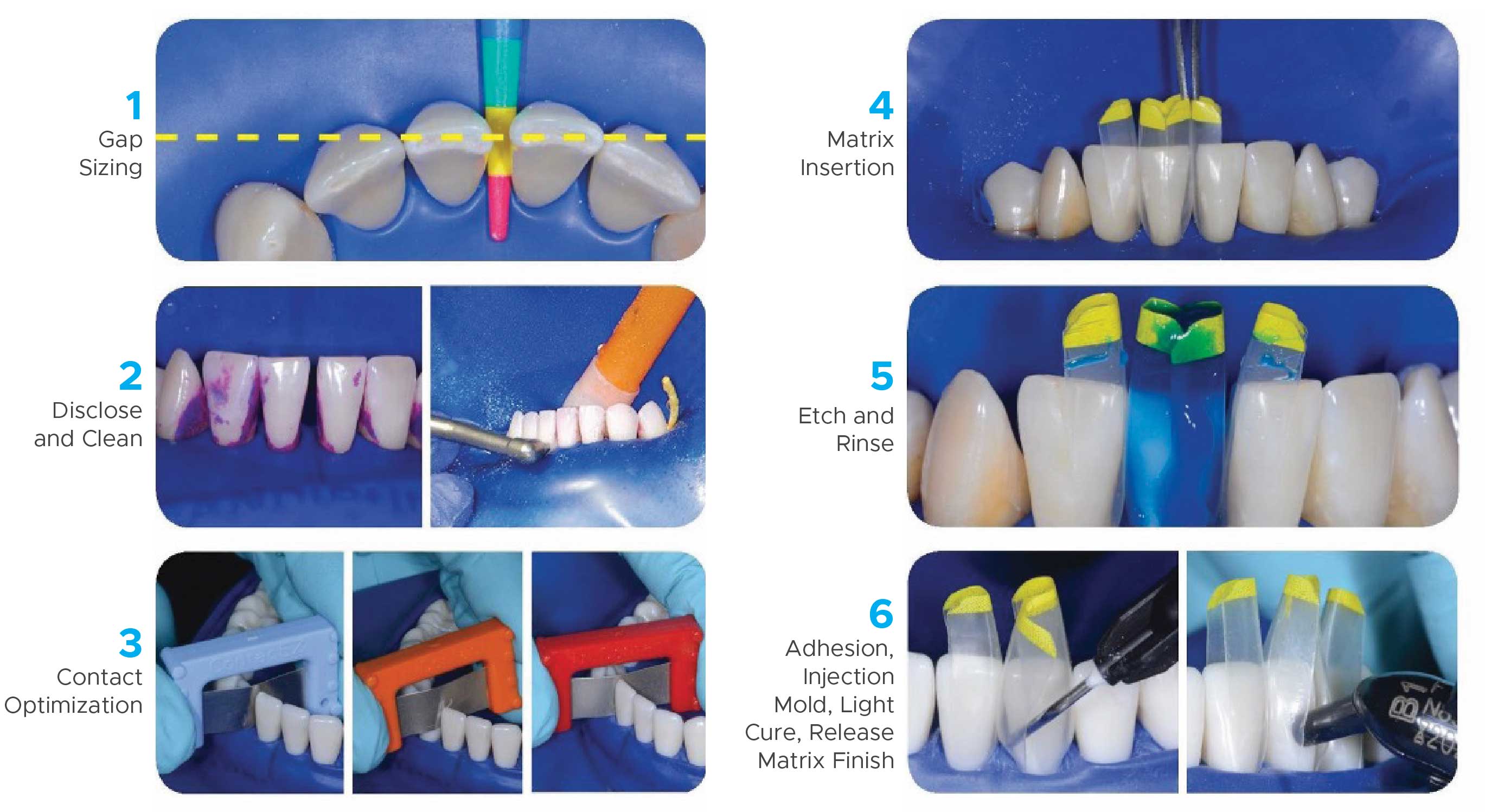 Black triangle teeth clinical technique