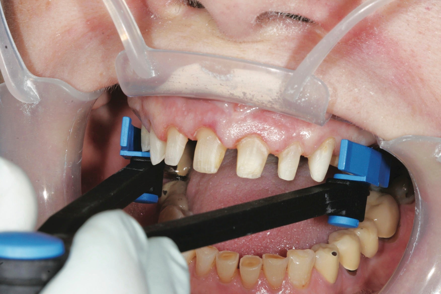 The Border-Lock Tray System includes a caliper to measure both the width and unique shape of the patient's arch.