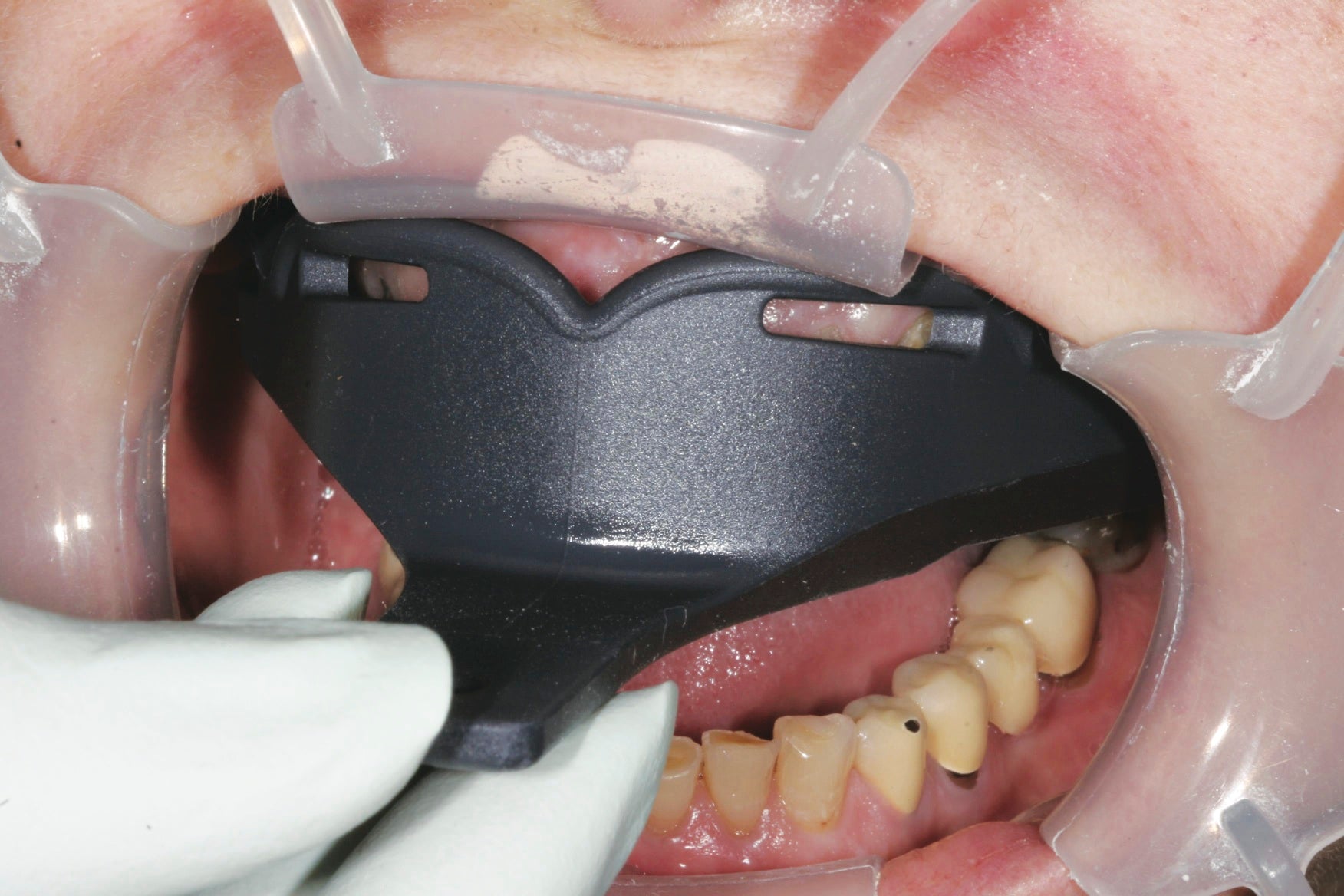 Try-in the Border-Lock tray prior to syringing impression material to ensure a correct fit.