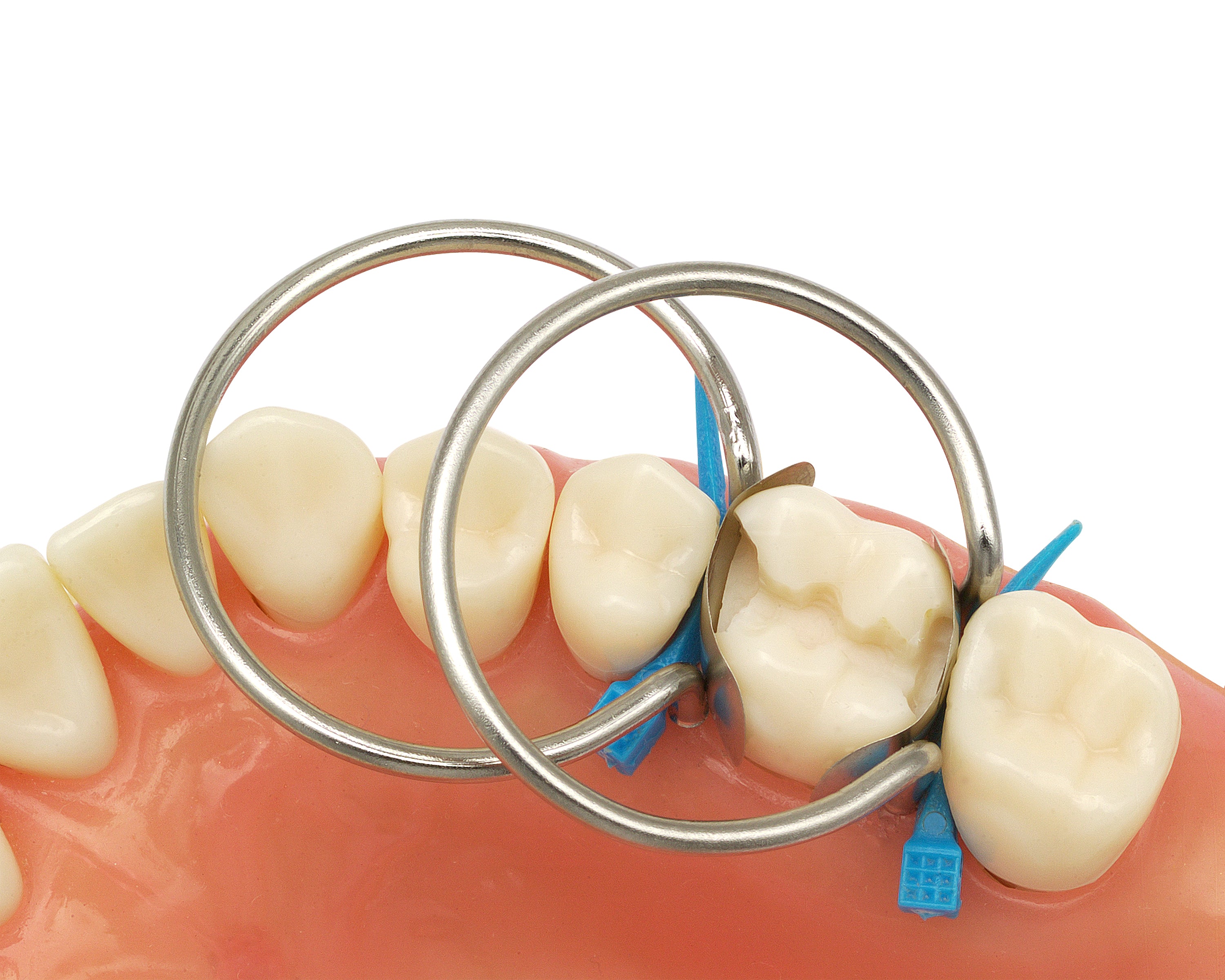 G-Ring Clinical Technique