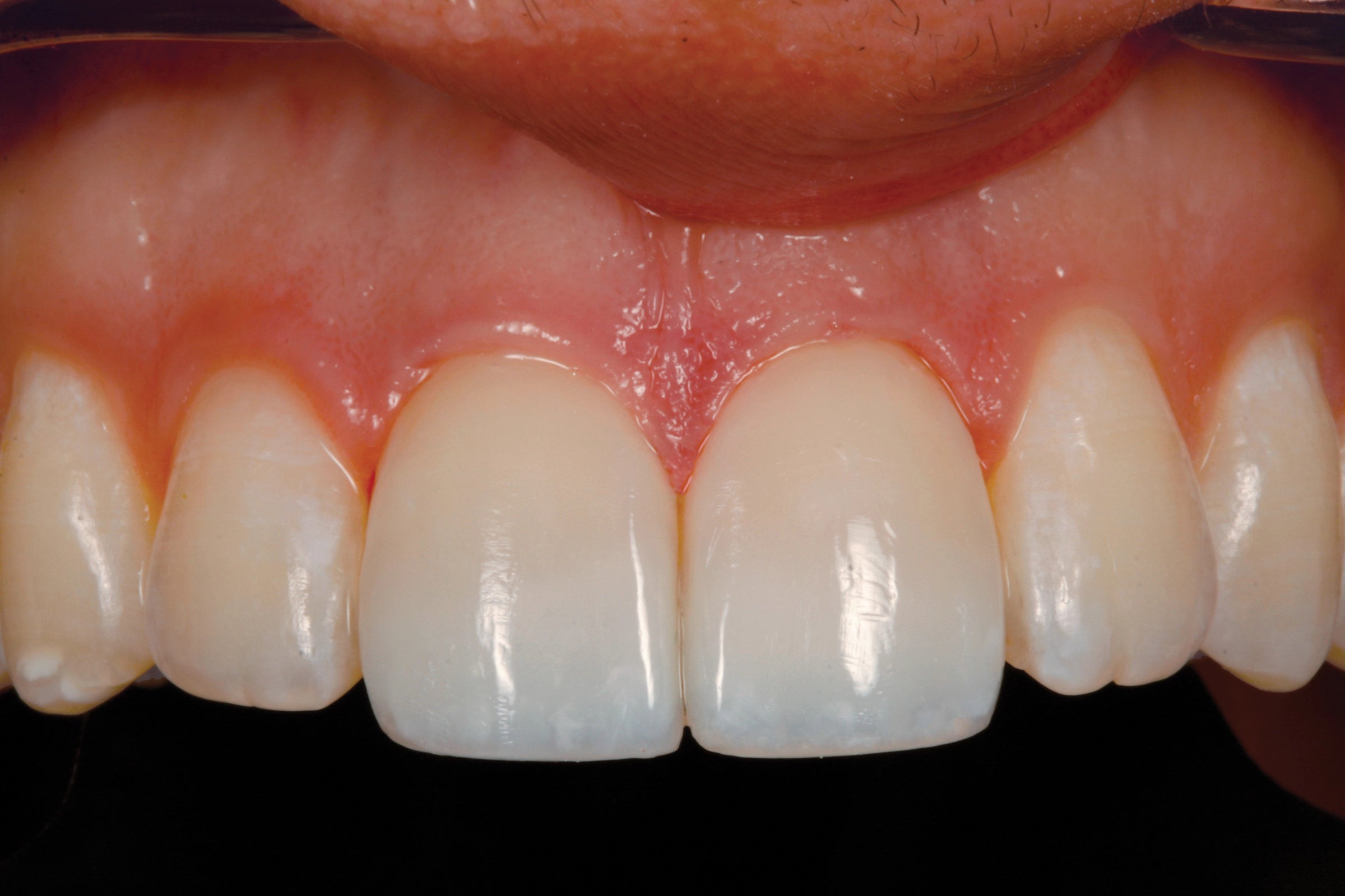 Anterior Class IV Restoration After Dr Chan uses Evanesce