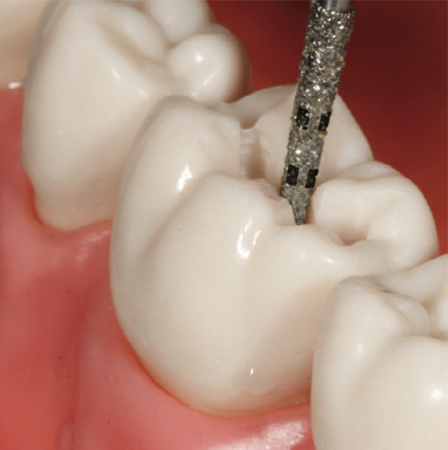 Komets 6847KRD dental diamond bur being used in a clinical setting