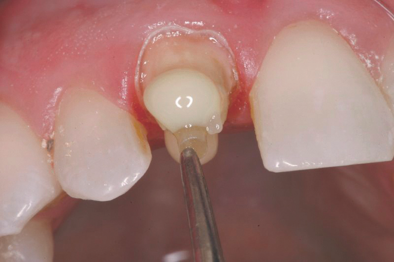 CosmeCore post placement