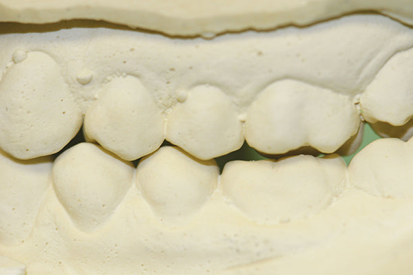 Alginate Derived Models Open Bite