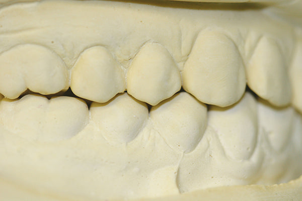 Counter-Fit Derived Model Closed Bite