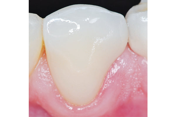 Final Polished Crown Intraoral