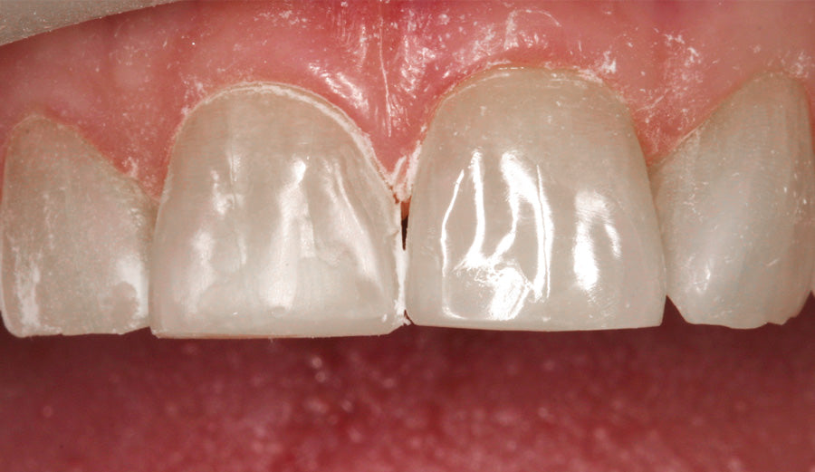 Upper right central composite veneer after pre-contouring with Contours Finishing and Polishing Discs.