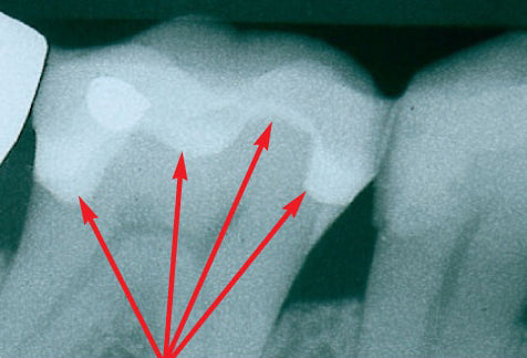 De-Mark used to line the cavity preparation.