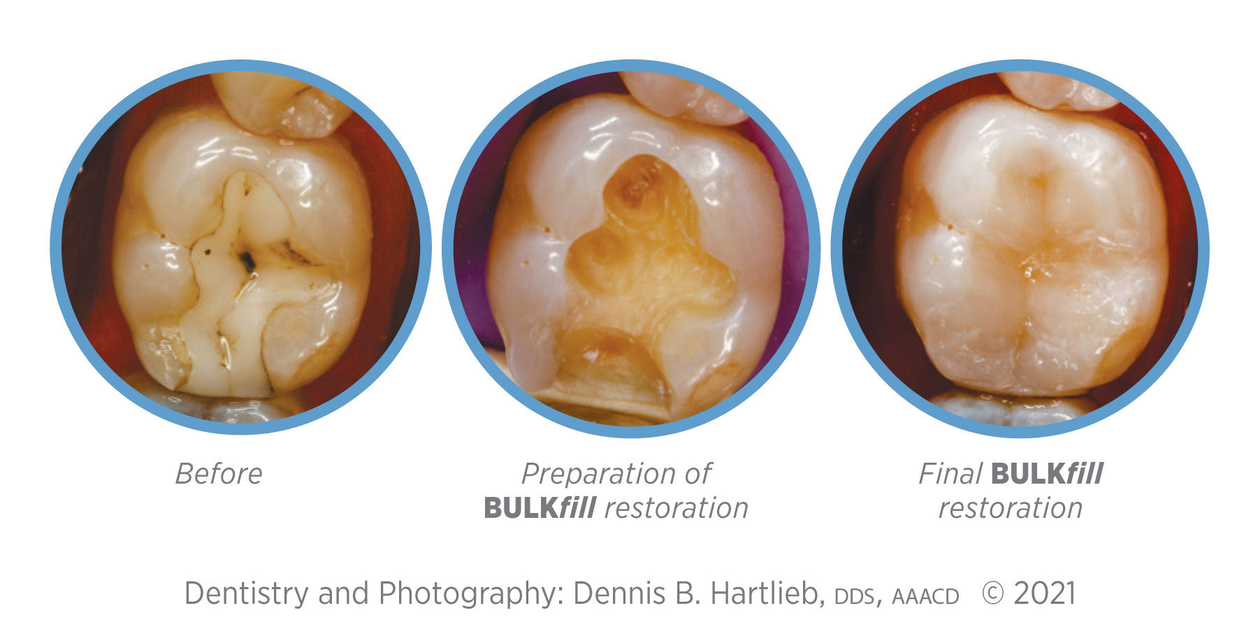 Dr. Dennis Hartlieb Cosmedent BULKfill Composite Restoration