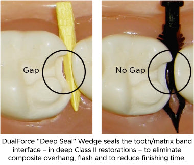 DualForce Deep Seal Wedge seals the tooth/matrix band interface - in deep Class II restorations - to eliminate composite overhang, flash and to reduce finishing time.