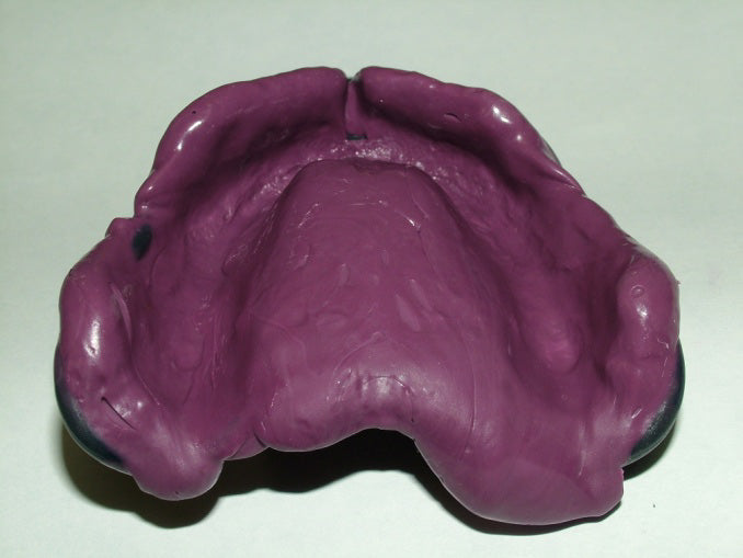 The final Monophase and Border-Lock Edentulous impression showing border moulding detail.