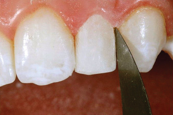 Instrument de contournage esthétique interproximal