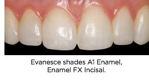 Anterior Re-Contouring and Black Triangle Closure Case After