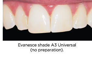 Conservative Incisal Repair Case After