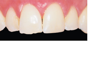 Conservative Incisal Repair Case Before