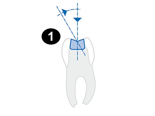 Drill out composite fillings in the usual manner