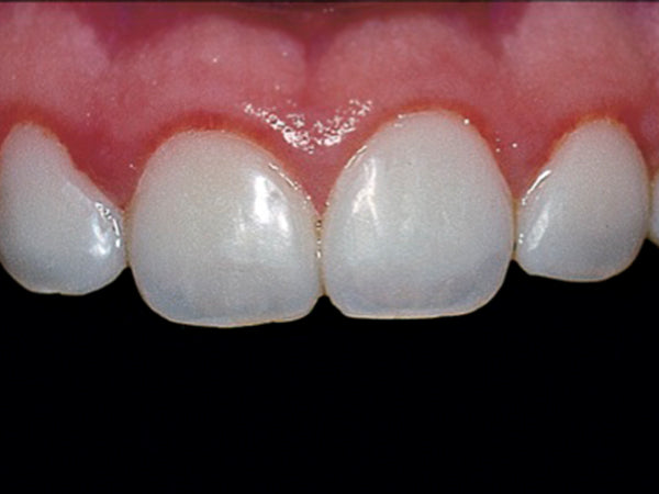 an image of a final restoration with Renamel Microhybrid composite