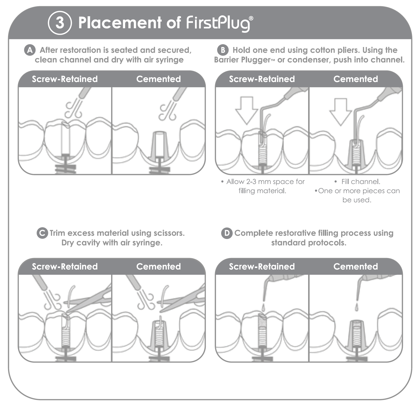 a clinical technique of how to use GirstPlug screw channel barrier