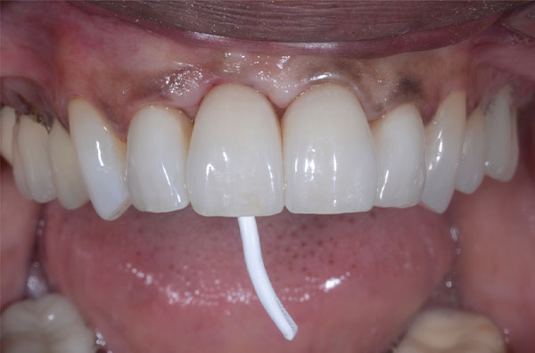 FirstPlug clinical example with a patient