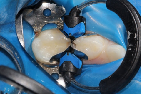 First and second primary molar