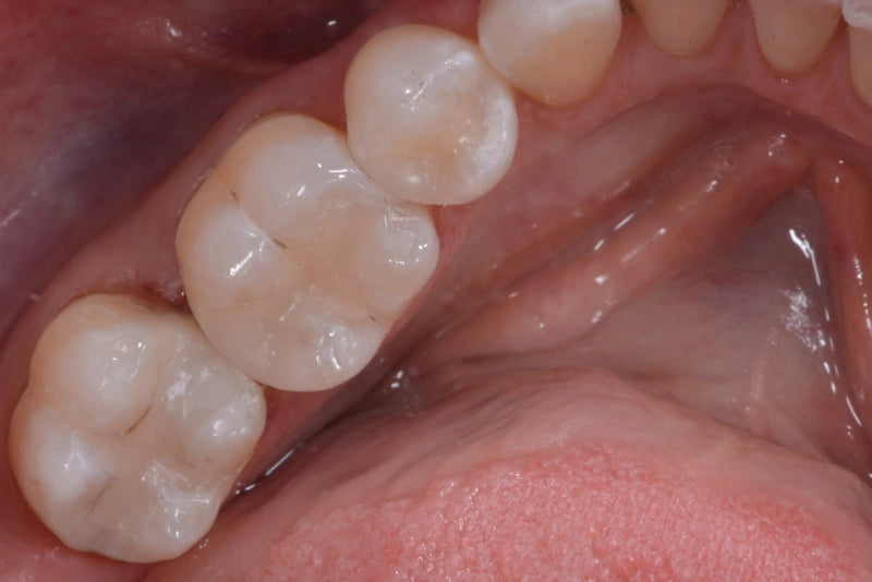 Posterior Class II Restoration After Dr Fred Peck uses Evanesce