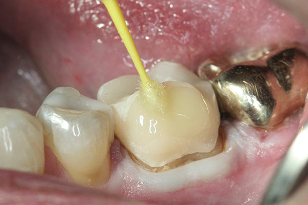 Glisten Intraoral Application