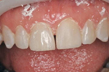 Upper Left Central Composite Veneer