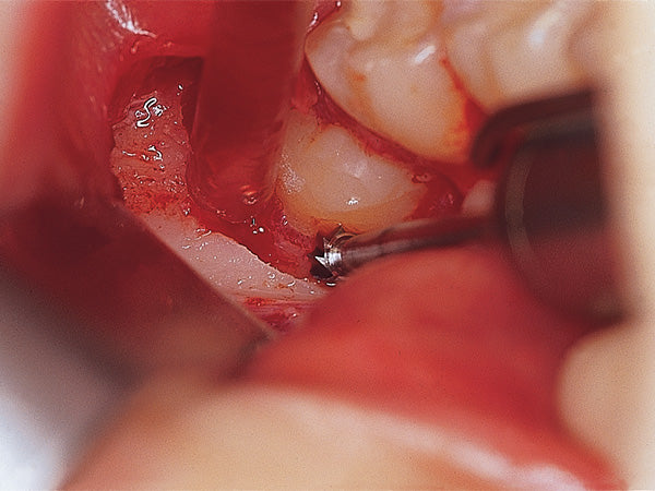 surgical application of H141