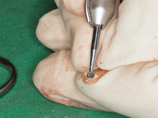 a photo of surgical application of H141 when cutting bones