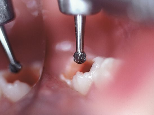 a photo showing an example of use for the H1SE bur when doing caries removal