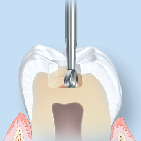 Komet H7 Pear Tungsten Carbide Clinical Technique