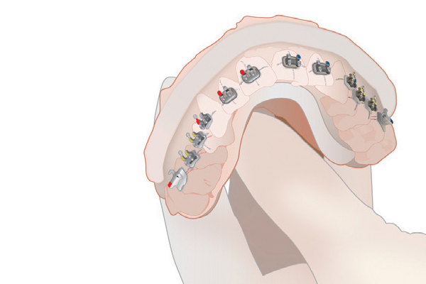 Take impression and bond brackets on stone model