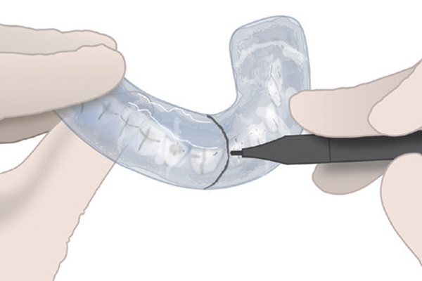 Proceed with bracket placement