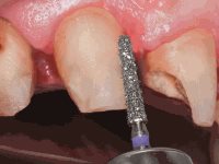 Komet 850XC Modified Tapered Deep Purple Diamond Crown Preparation Bur Clinical Technique Step 1