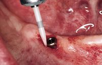 Komet KT CeraTip Gingival Tissue Trimming Bur Implant