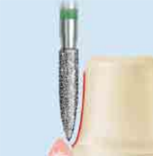 Komet 8888 Diamond Preparation Bur Clinical Technique