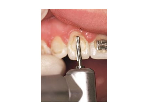 Komet H22ALGK Round End Orthodontic Adhesive Remover Clinical Technique