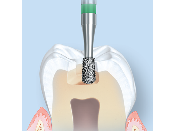 Fraise de préparation de cavité S6830L S-Diamond® en cours d'utilisation