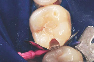 After caries removal and placement of the matrix band and wedge, thoroughly clean and dry the preparation.