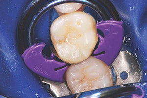 Proceed with placement and light-curing of the composite. A bulk-fill composite was used in this case.