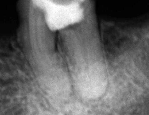 Initial clinical and radiographic appearance of teeth 36