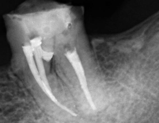 Clinical and radiographic appearance of
drilling filling with MTA Repair HP